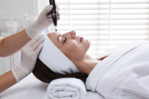 How Does Microneedling Help Improve Acne Scars